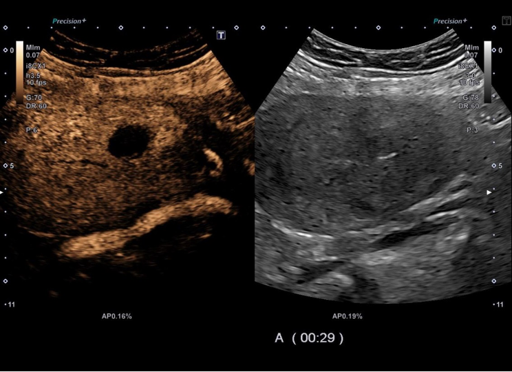 Ultrasound vs. MRI to detect uterine leiomyomas