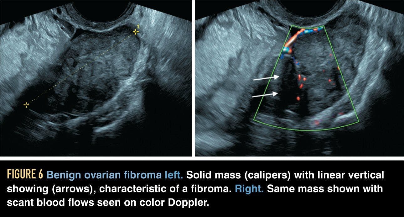 Benign ovarian fibroma