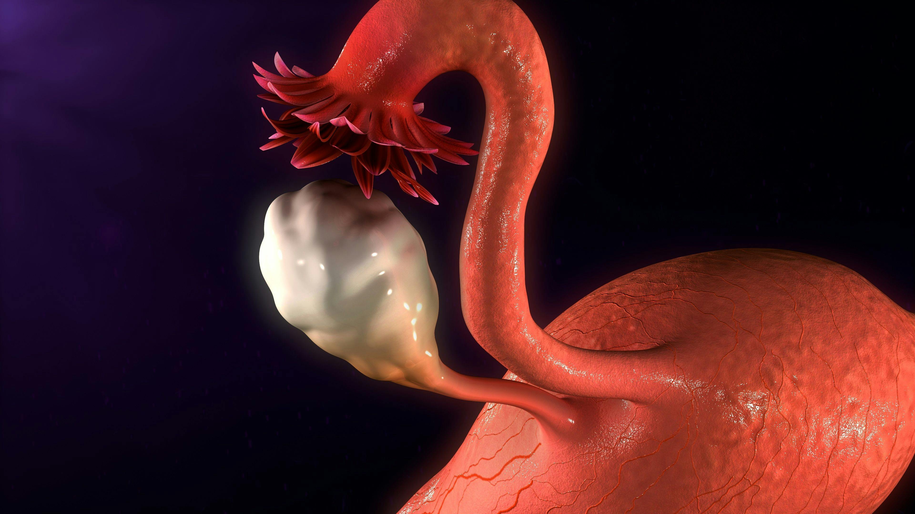 Appraisal of current uterine fibroid management guidelines