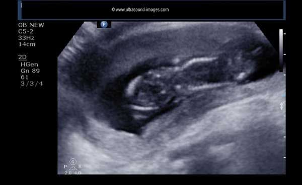 DailyDx: A 12-Week Fetus