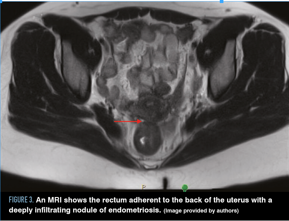 Figure 3. An MRI shows the rectum adherent to the back of the uterus with a deeply infiltrating nodule of endometriosis. (Image provided by authors)