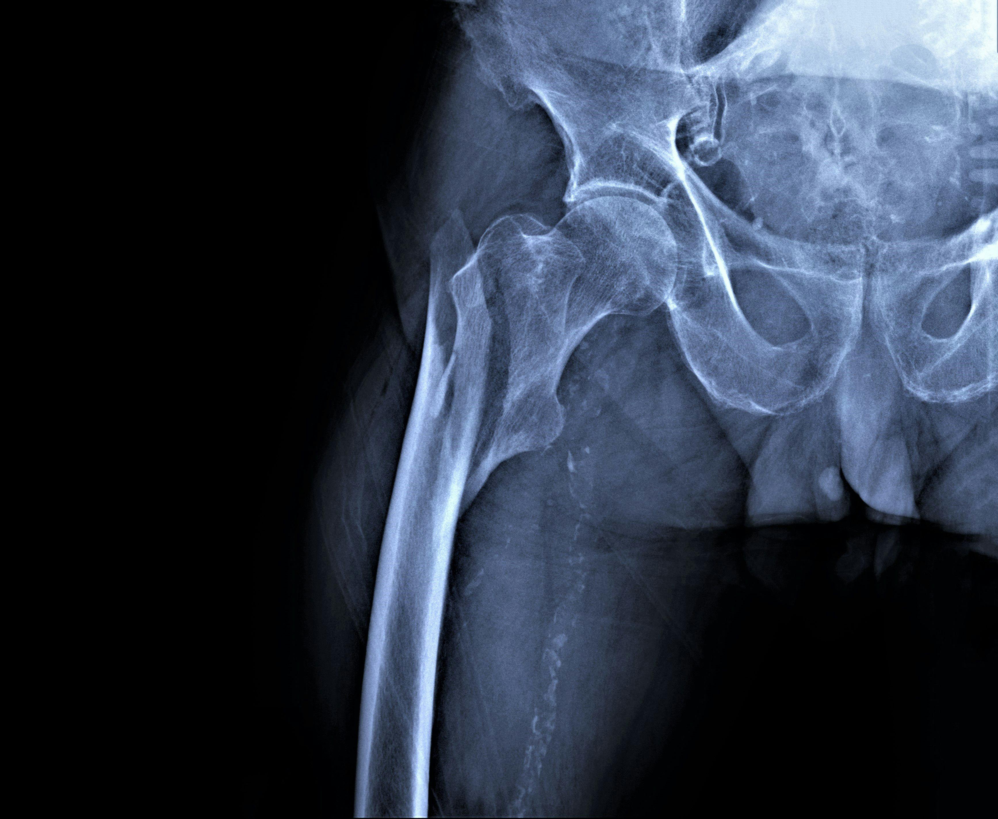 Study finds global hip fractures expected to double by 2050