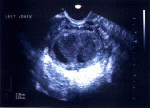 TRV Adnexa (Transvaginal) Tubo-Ovarian Abscess (TOA)
