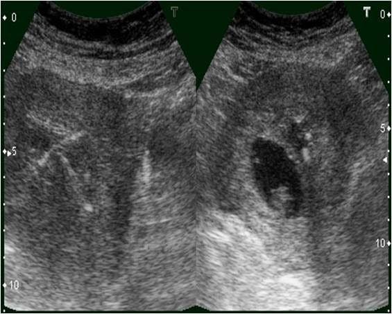 IUCD with Pregnancy IUCD, copper T in uterus with Gestational sac