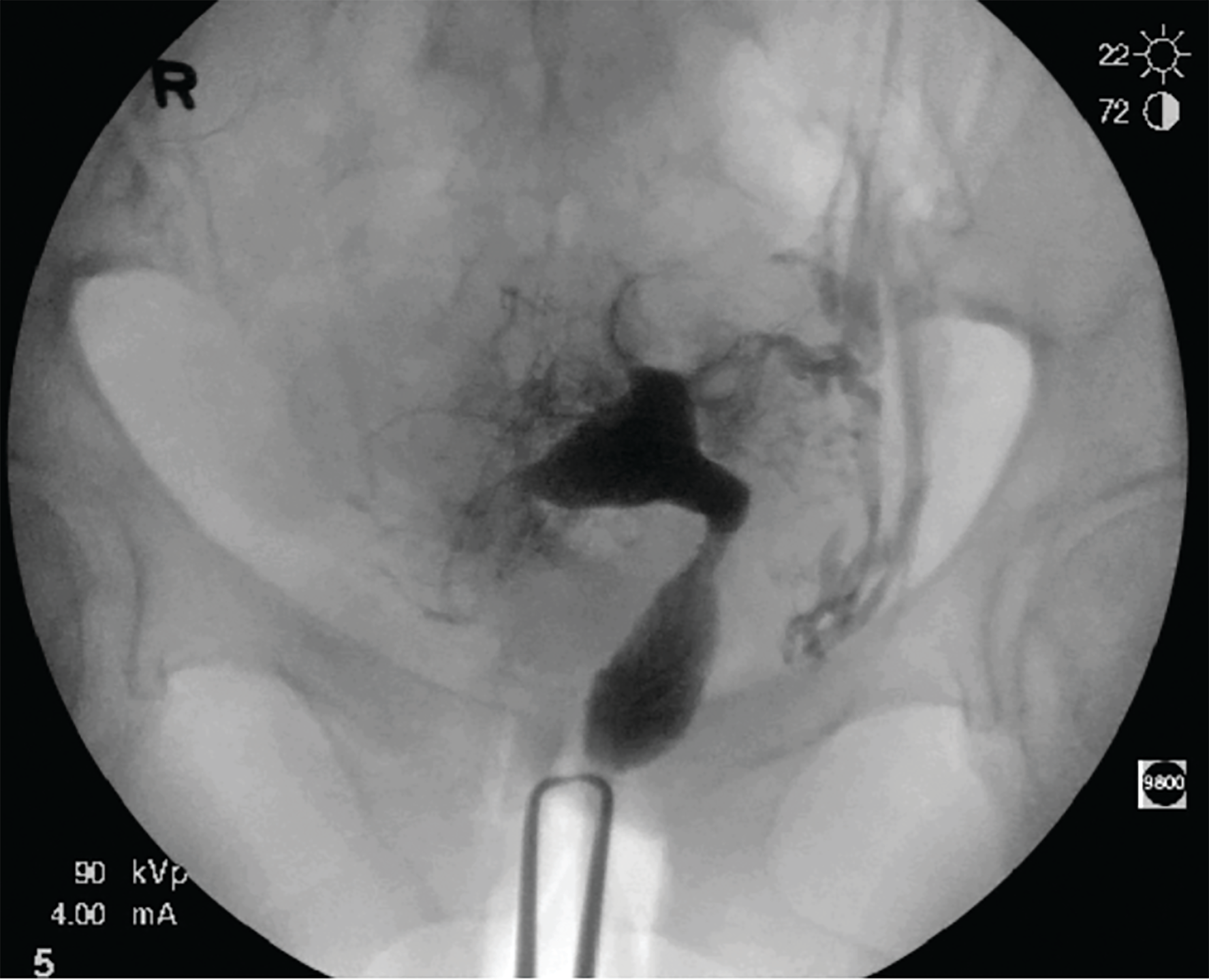 FIGURE 2. Hysterosalpingogram depicting a normal uterine contour without
intrauterine-fi lling defects and bilateral intravasation of contrast agent into the myometrial vessels and pelvic veins. Special attention is required not to confuse this with tubal fi ll and spill such as in the left aspect of this study where the difference can be noted by not being able to trace it back to the cornua.