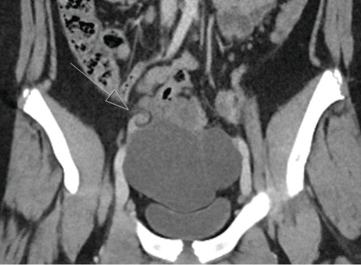 Figure 2. Whirlpool sign on CT scan (arrow). This patient had bilateral paratubal cysts and right adnexal torsion on laparoscopy. (Printed with patient permission)