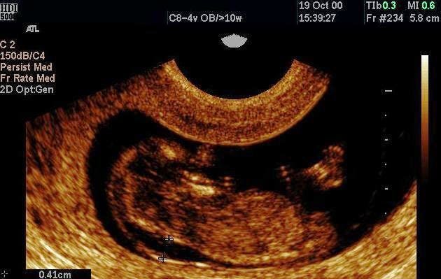 LONG Fetus Increased Nuchal Translucency