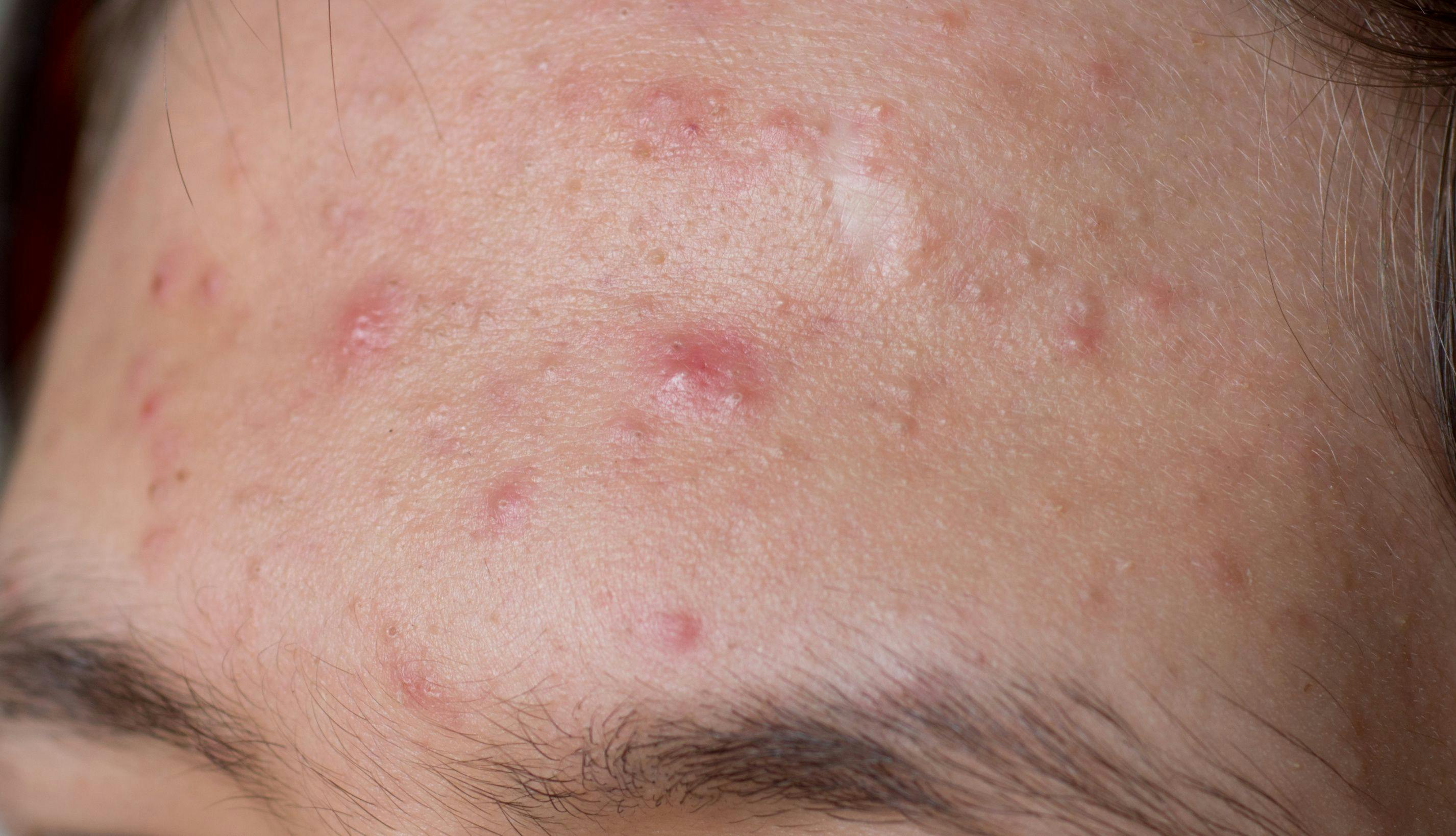 Treating acne in transgender patients on testosterone