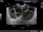 DailyDx: What is The Diagnosis of This Ovary?