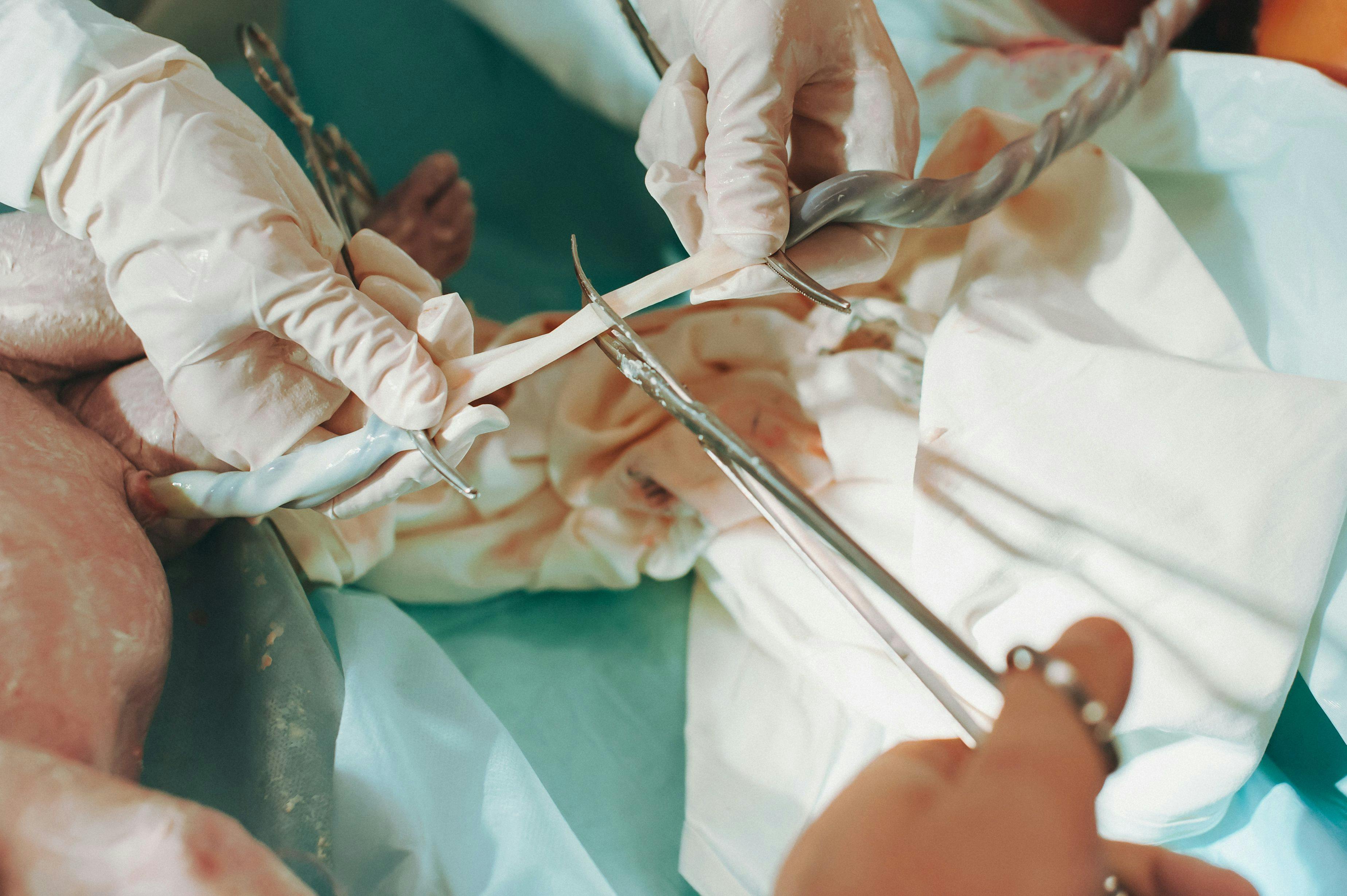 Placental cord drainage may be simpler, more effective than standard practice