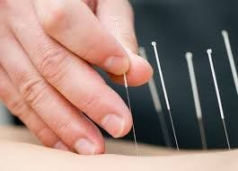 Women Seem to Benefit From Acupuncture for Hot Flashes