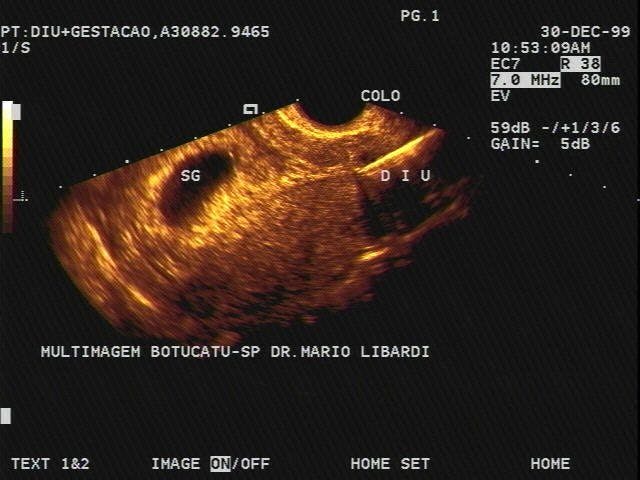 SAG Uterus (Transvaginal) Early Pregnancy, IUCD in cervix