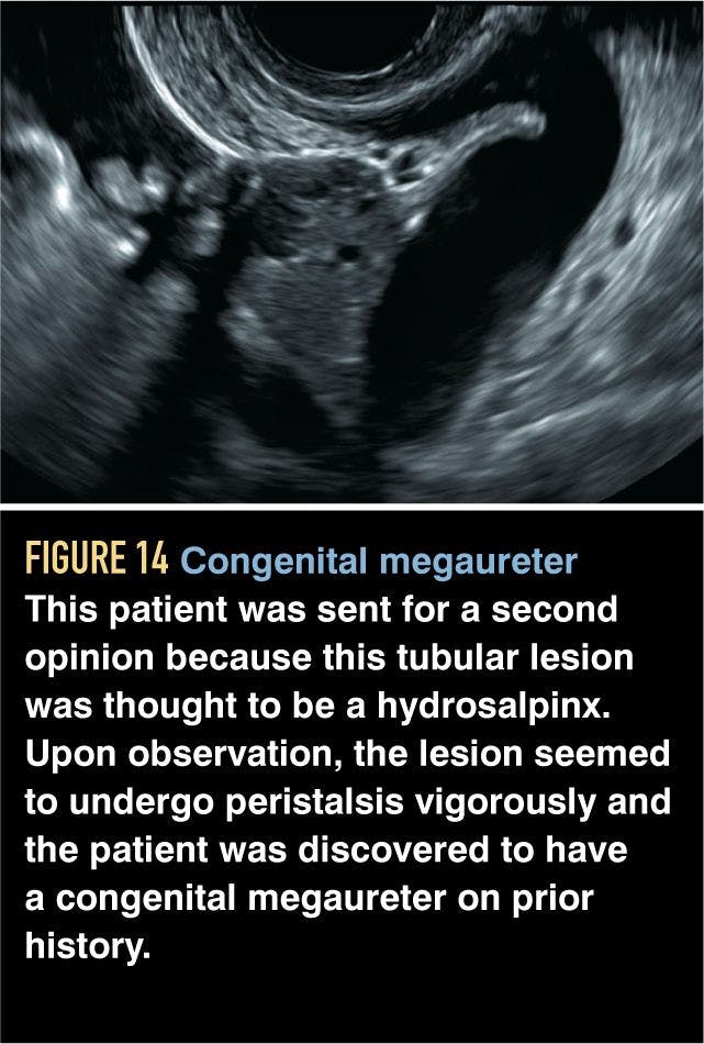 Congenital megaureter