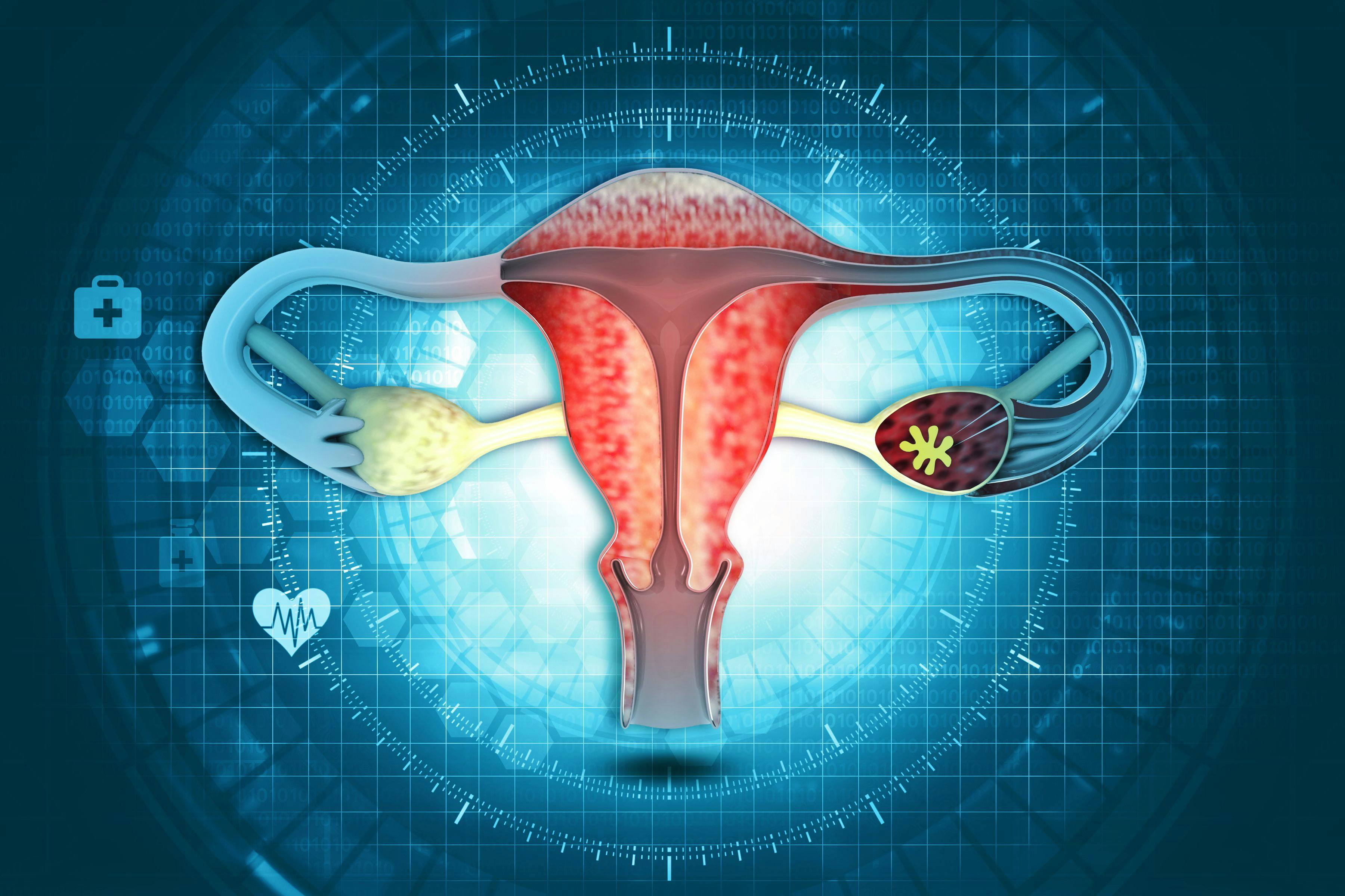 Radiofrequency ablation of uterine fibroids