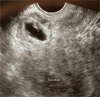Cesarean Scar Ectopic Pregnancy - A Case Presentation