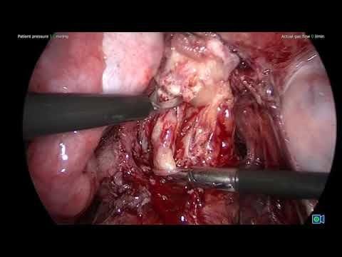 Video: Laparoscopic excision of multifocal bowel endometriosis