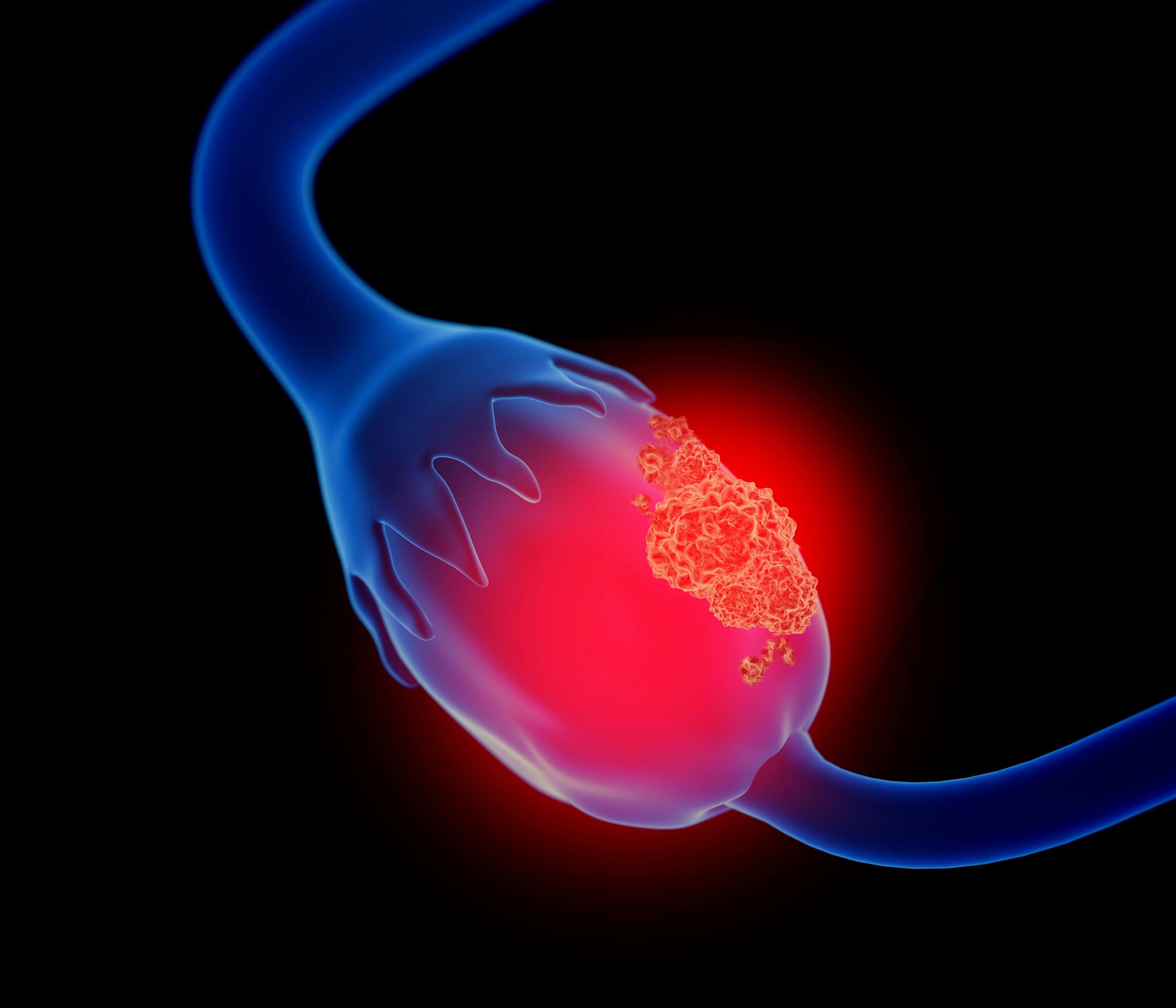 What’s new in biomarker testing for ovarian cancer