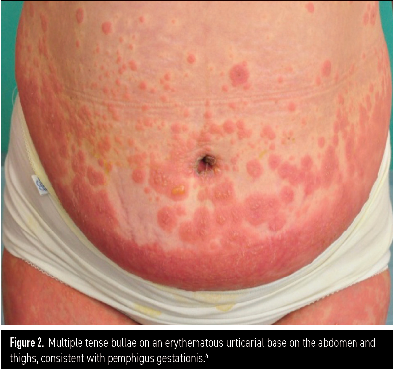 Figure 2. Multiple tense bullae on an erythematous urticarial base on the abdomen and thighs, consistent with pemphigus gestationis.4