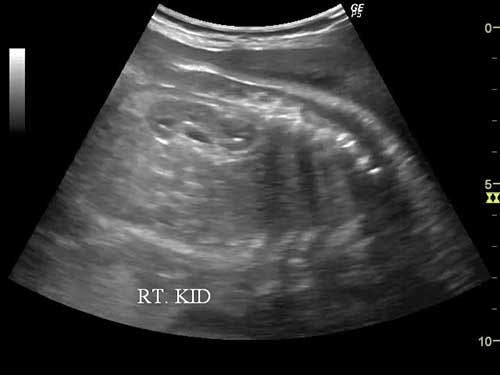 Image IQ: Fetal Kidneys