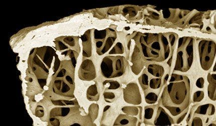 Osteoporosis Drugs Good for Bones but Not Breast Cancer Prevention