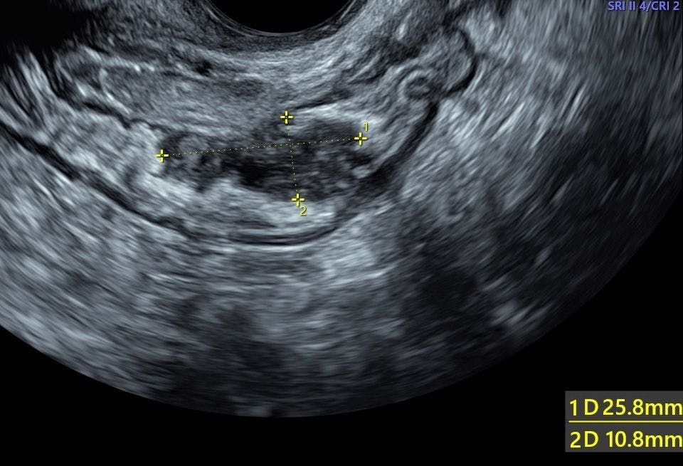 Ultrasound images: Gynecologic diagnoses (Part 1)