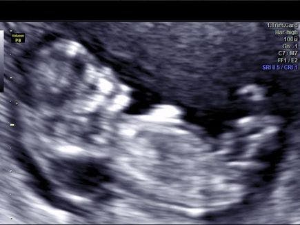 Image IQ: The Fetal Neck