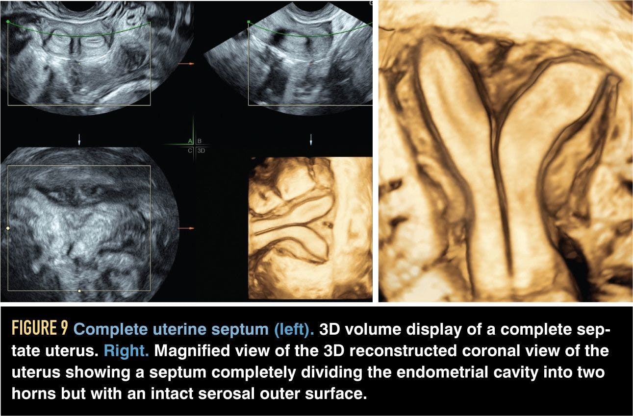Complete uterine septum
