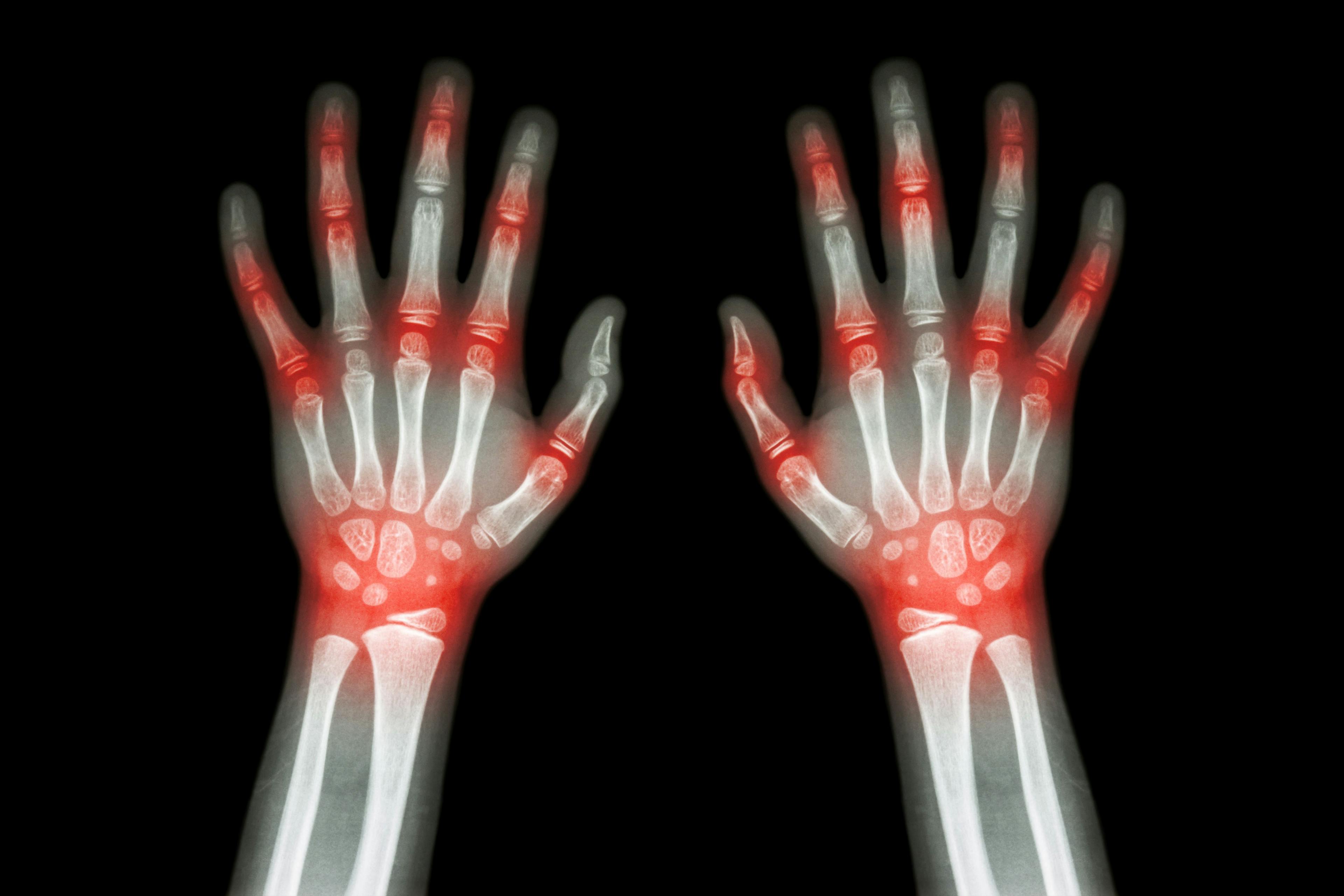 Rheumatoid arthritis| Image Credit: © stockdevil- © stockdevil - stock.adobe.com.