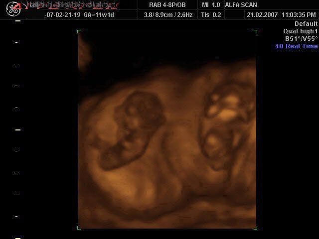 Twin Pregnancy 11Wks 4D ultrasound